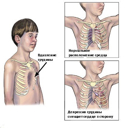 Create meme: sunken chest, funnel- shaped chest, chest deformity