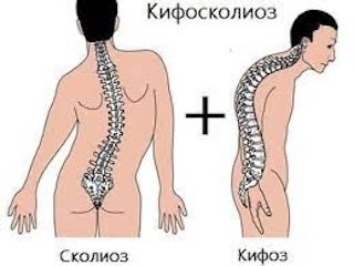 Создать мем: кифоз, искривление позвоночника кифоз, кифоз лордоз сколиоз