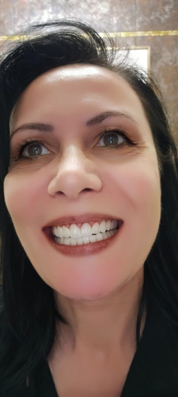 Create meme: teeth after braces, veneers for teeth, braces teeth