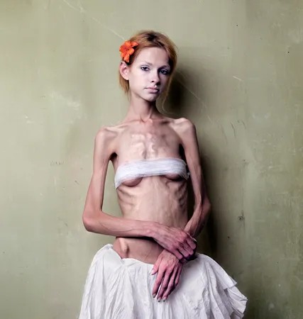 Create meme: anorexia , the thinnest woman, anorexia and bulimia