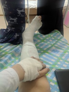 Create meme: leg in plaster, a broken leg