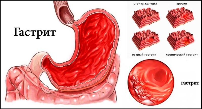 Create meme: gastritis , acute catarrhal gastritis, acute gastritis