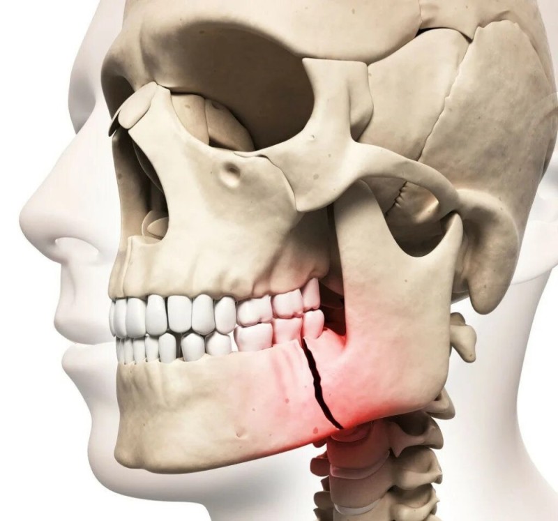 Создать мем: перелом челюсти, перелом нижней челюсти, нижняя челюсть