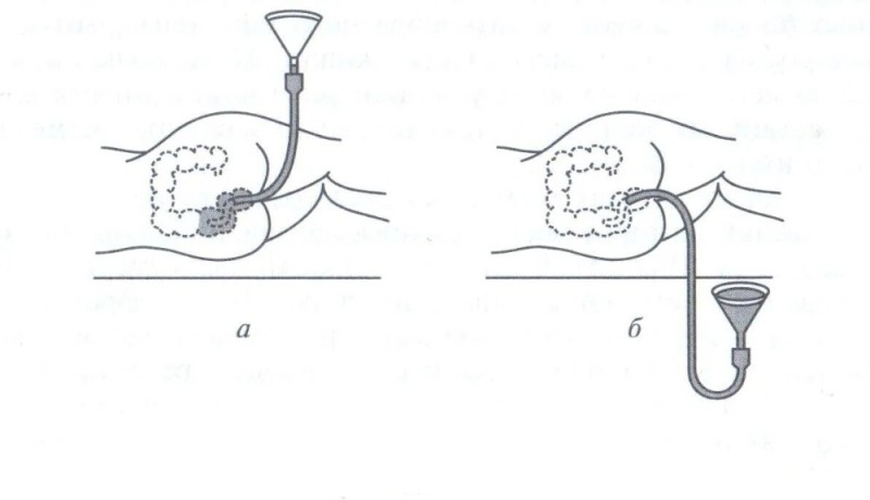 Create meme: the technique of setting a siphon enema, setting up a siphon enema, setting up a cleansing enema