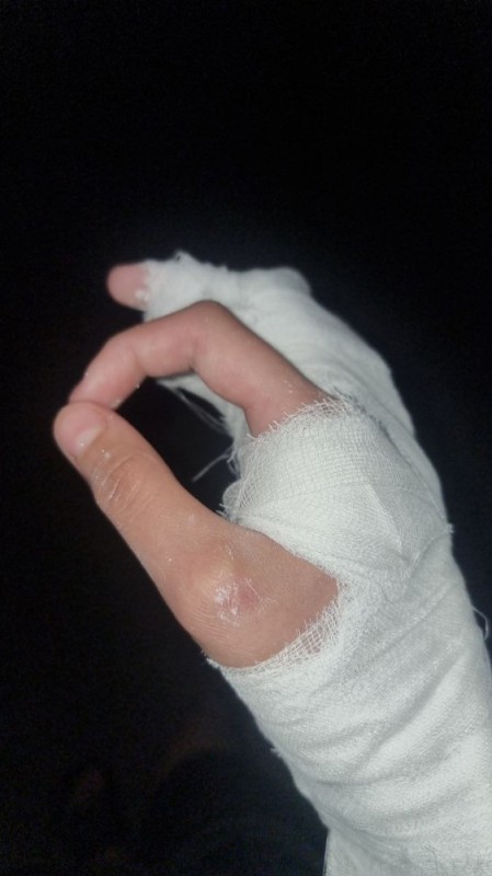 Create meme: body part, broken finger, bandaged hand