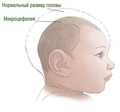 Создать мем: микроцефалия головного мозга у новорожденных, микроцефалия головного мозга, микроцефалия врожденная