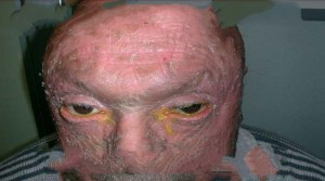 Create meme: people, congenital ichthyosis, ichthyosis in humans