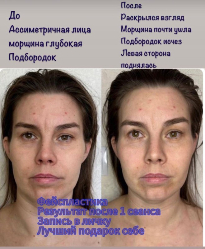 Create meme: face peeling, facial rejuvenation, face lifting