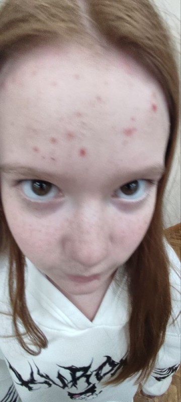 Create meme: zits, acne pimples, pimply face