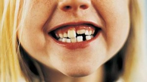 Create meme: teeth, malocclusion of deciduous teeth in children, malocclusion