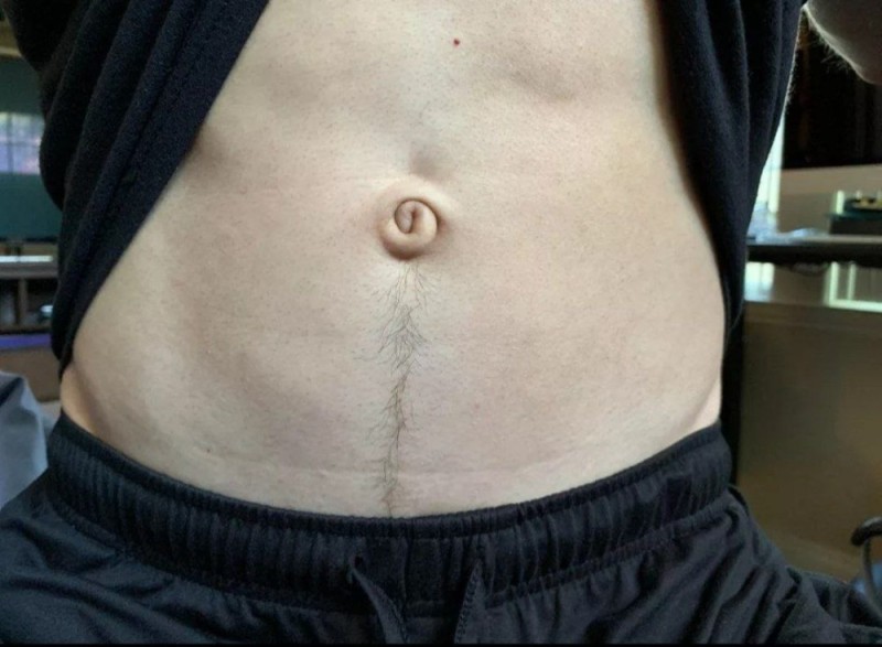Create meme: ivan Petrov's outie belly button, umbilical hernia, umbilical hernia in adults