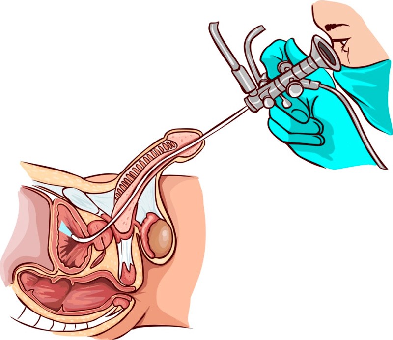 Create meme: foreign bodies of the urethra, transurethral resection of the prostate gland, urethral instillation