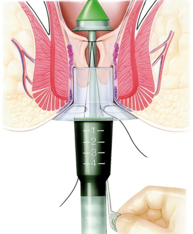 Create meme: hemorrhoid prolapse, longo's operation for hemorrhoids, hemorrhoids