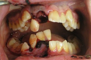 Create meme: cavities on the teeth photo, horrible tooth decay, photos of the teeth of the smoker
