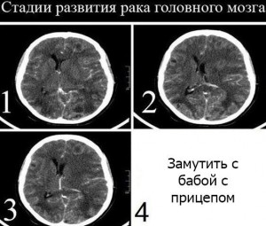 Рак Головного Мозга Фото