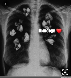 Рентген бабочки в животе картинка