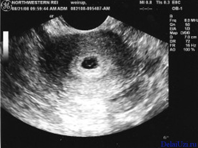 Create meme: ultrasound in the early stages, ultrasound at 6 weeks, ultrasound in pregnancy