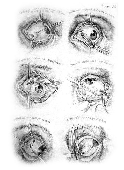 Create meme: resection of the eye muscle, plastic surgery of the eye slit, conjunctival cavity of the eye