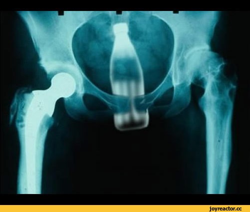 Create meme: hip replacement, hip replacement X-ray, hip joint prosthesis