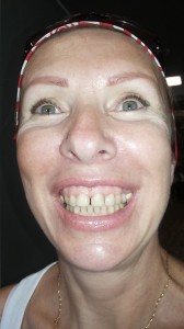 Create meme: veneers, woman, teeth