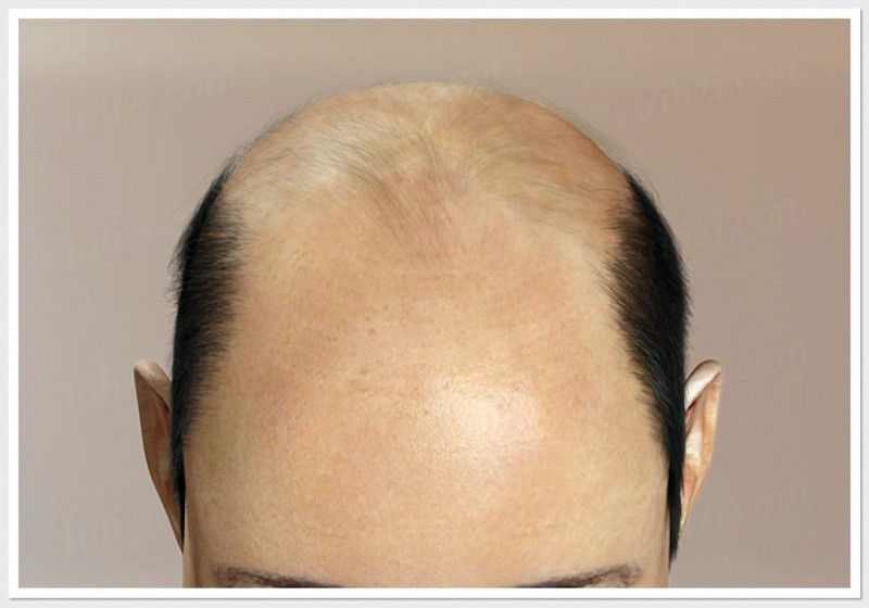 Create meme: androgenic alopecia of whiskey, bald head with hair on the sides, bald head