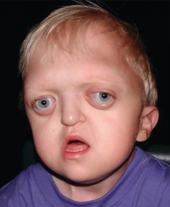 Create meme: syndrome, facial reconstruction with the syndrome of crouzon, crouzon syndrome