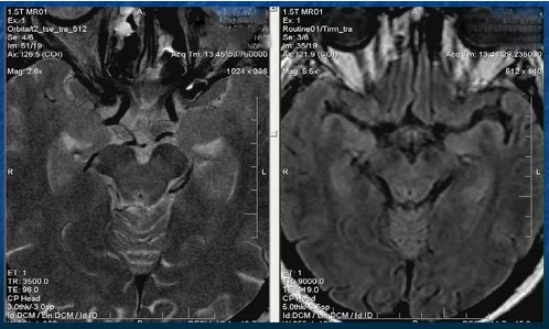 Create meme: optic nerve glioma mri, paraganglioma of the jugular glomus mri, VSD on an MRI of the head