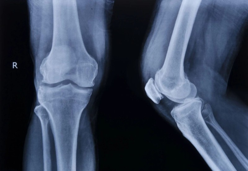 Create meme: X-ray of the knee joint, X-ray of a healthy knee joint, X-ray of a healthy knee