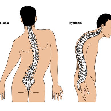 Create meme: kyphosis of the thoracic spine, scoliosis kyphosis kyphoscoliosis, curvature of the thoracic spine kyphosis