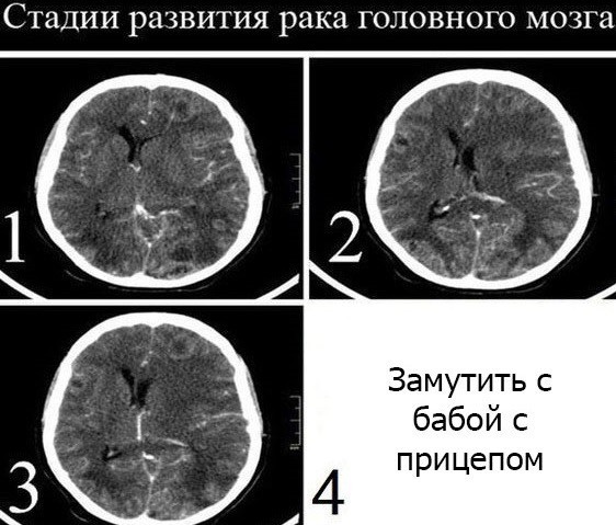 Sozdat Komiks Mem Rak Golovnogo Mozga Zlokachestvennaya Opuhol Rak Golovnogo Mozga Simptomy Rak Golovnogo Mozga Mashina Komiksy Meme Arsenal Com