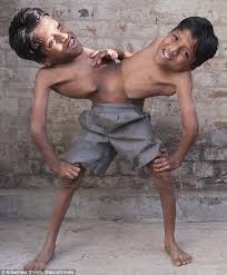 Create meme: Indian conjoined twins shivanath, separation of siamese twins, The first Siamese twins