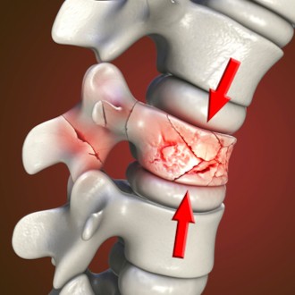 Создать мем: грыжа поясничного отдела позвоночника, compression fracture, стрессовый перелом позвоночника