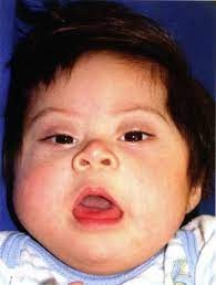 Create meme: mumps in children, mucopolysaccharidosis Gurler syndrome, down syndrome trisomy