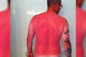 Create meme: sunburn, tan, burned in the sun