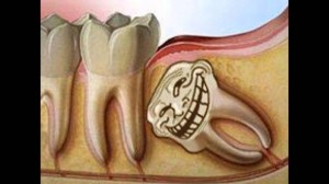 Создать мем: язычный тип зуба мудрости, пульпит 3.6 зуб, верхняя восьмерка зуб