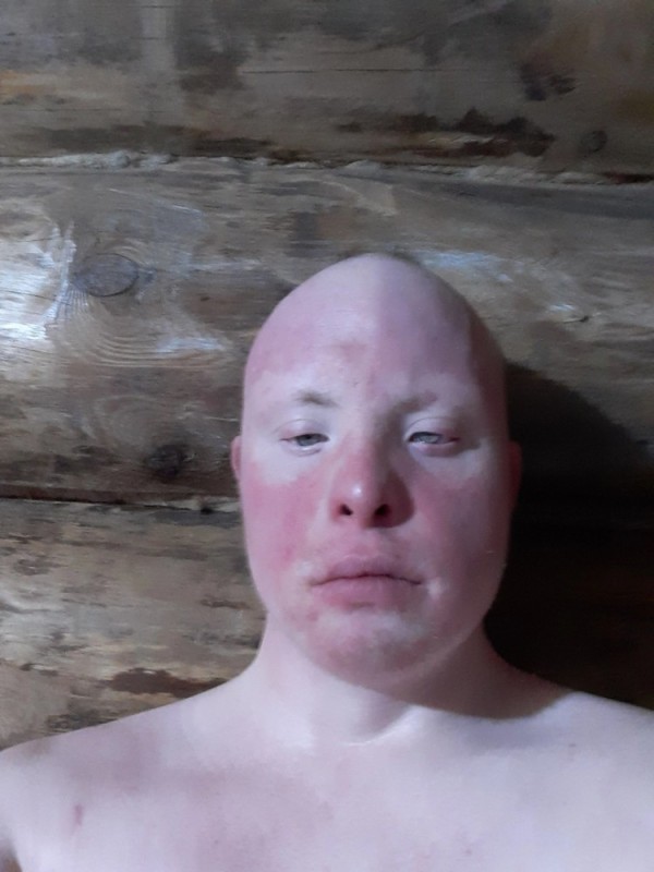 Создать мем: альбинизм мальчики, альбинос, лицо