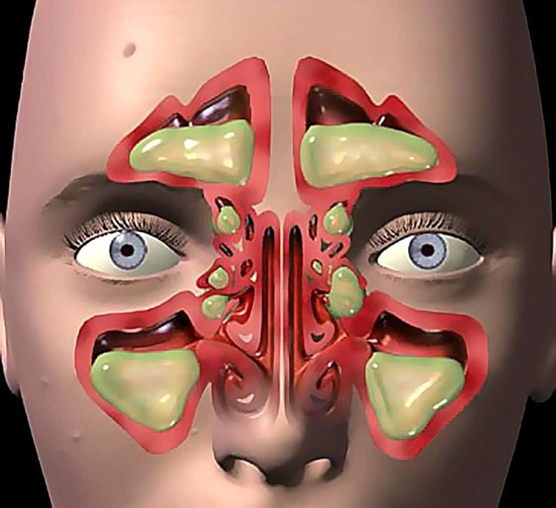 Создать мем: гемисинусит, пазухи носа, катаральный гайморит