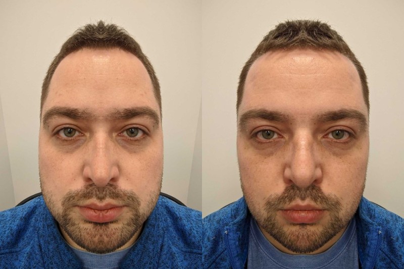 Create meme: before and after, otoplasty, face 