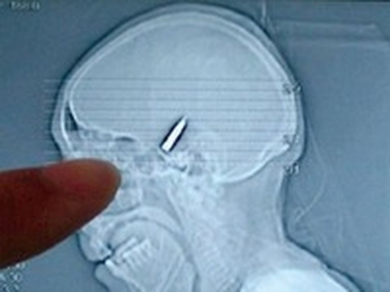 Create meme: x-ray, Bullet in the head, Nail in the head X-ray