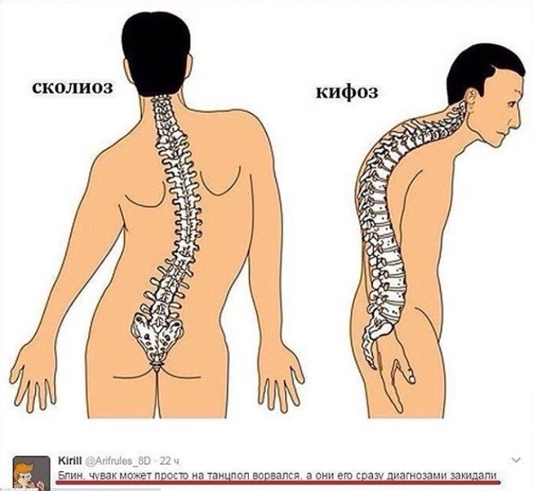 Сколиоз рисунок позвоночника