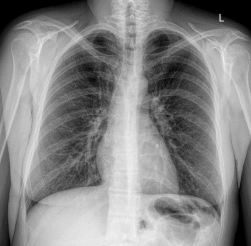 Create meme: a chest x-ray, pneumothorax of the lungs X-ray, chest X-ray