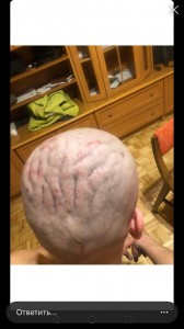 Создать мем: hair transplant, hair transplantation, пахидермия