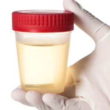 Создать мем: прозрачная моча, хлопья в моче, urine specimen