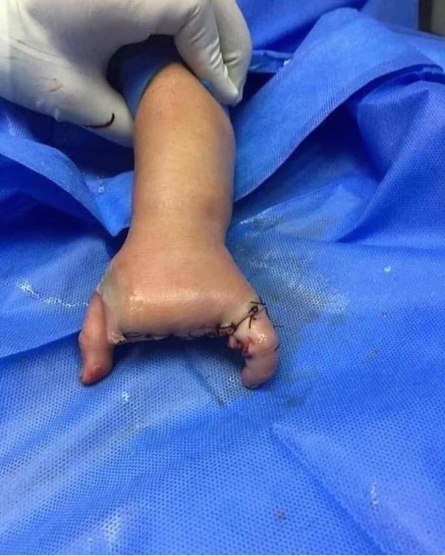 Create meme: brachydactyly of the thumb surgery, fingers , operation 